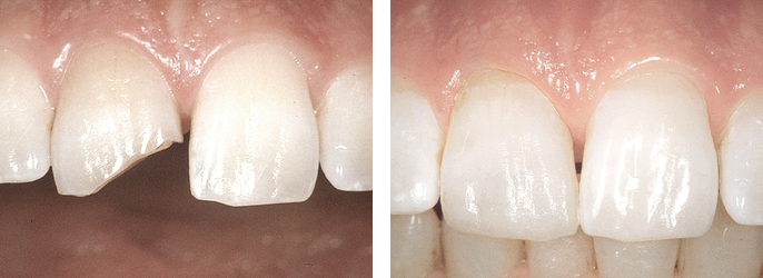 реставрация КОМПОНИРами - потеря существенной части переднего зуба в результате скола