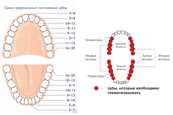 какие зубы нужно герметизировать