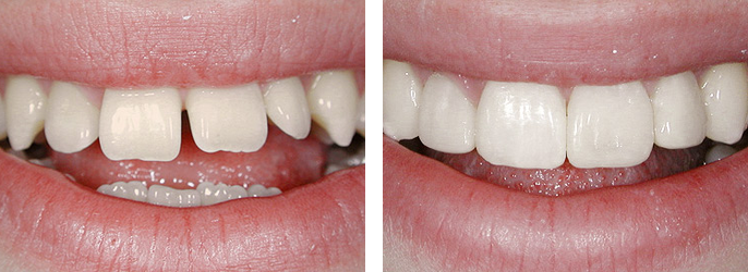 реставрация КОМПОНИРами - диастема и слишком длинные передние зубы