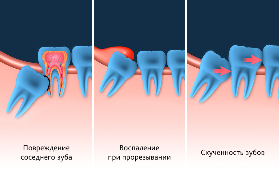 Удаляют ли семерки. Удаленные зубы мудрости.