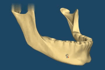 костная ткань быстрей всего убывает в боковых отделах верхней и нижней челюсти