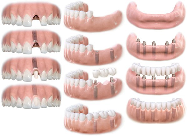 восстановление одного, нескольких и всех зубов с использованием протезирования на имплантатах