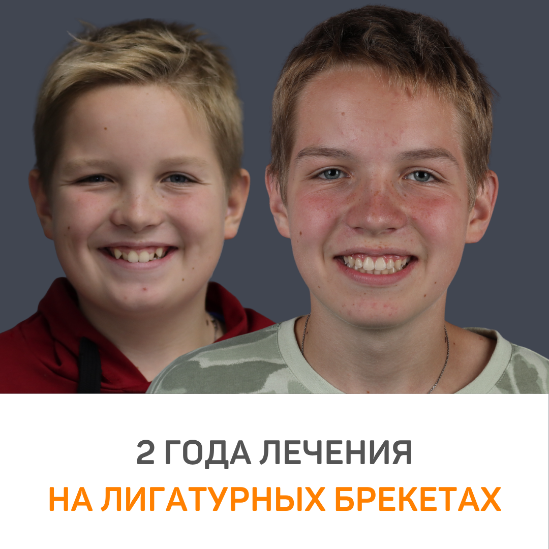 2 года лечения на лигатурных брекетах